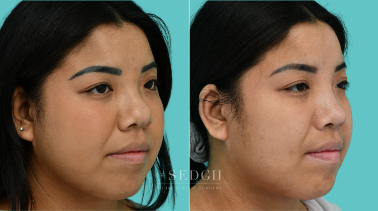 Patient 377 after Asian Rhinoplasty, view 1