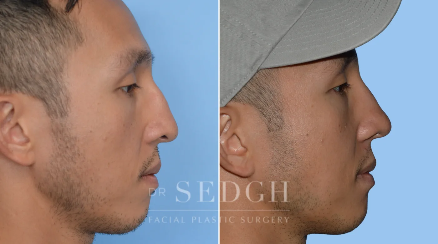 Patient 68 after Asian Rhinoplasty, view 1