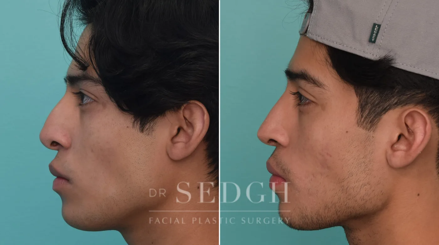 Patient 201 after Revision Rhinoplasty, view 2