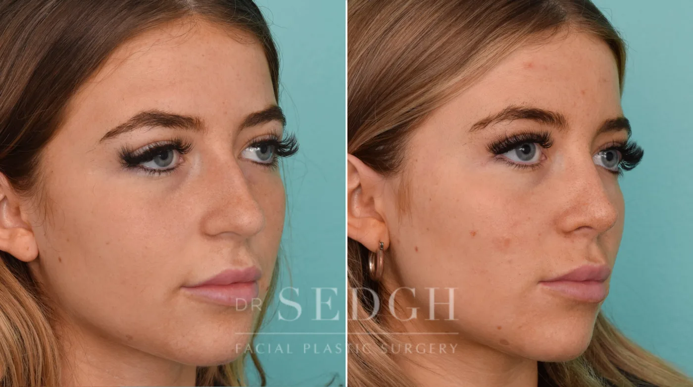 Patient 242 before Rhinoplasty, view 1