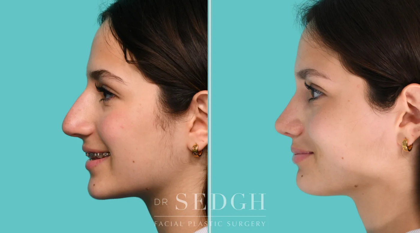 Patient 350 after Middle Eastern Rhinoplasty, view 1