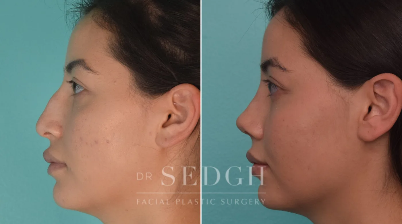 Patient 191 after Female Rhinoplasty, view 1