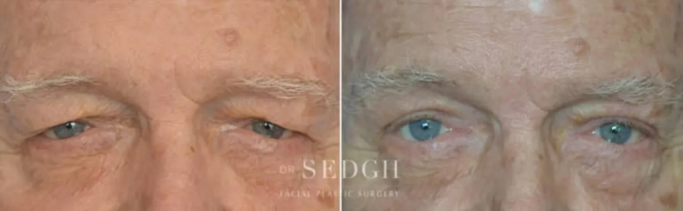 Patient 1 before Upper Blepharoplasty, view 1
