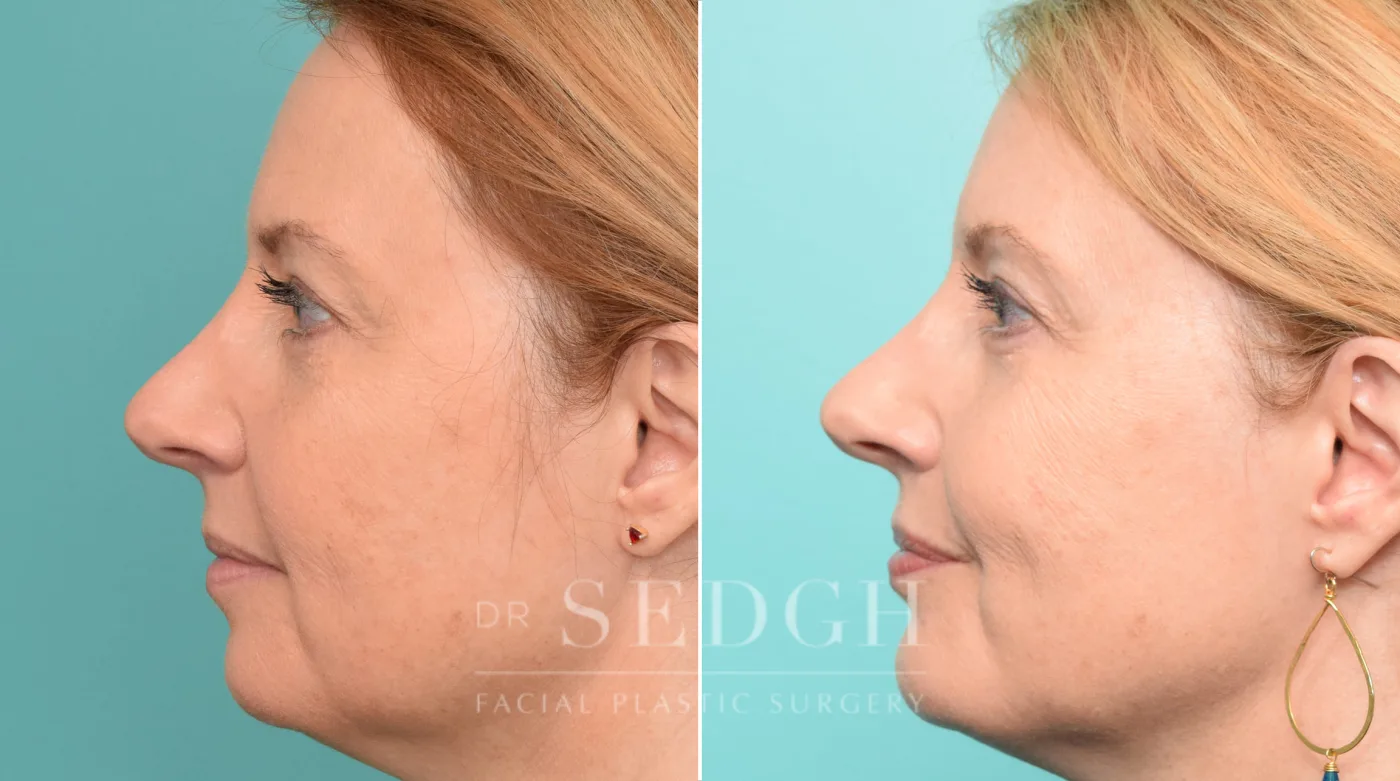 Patient 281 after Chin Augmentation, view 1