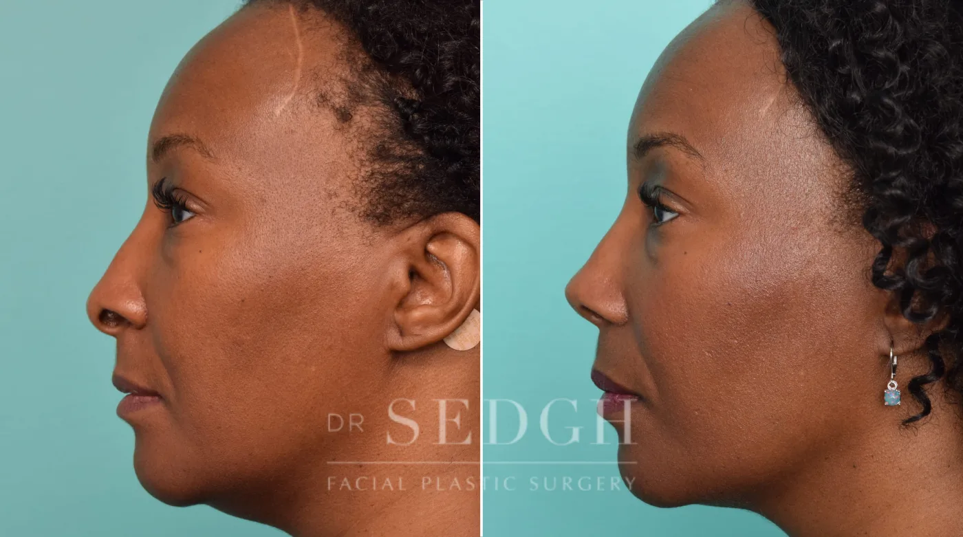 Patient 246 after African American Rhinoplasty, view 1