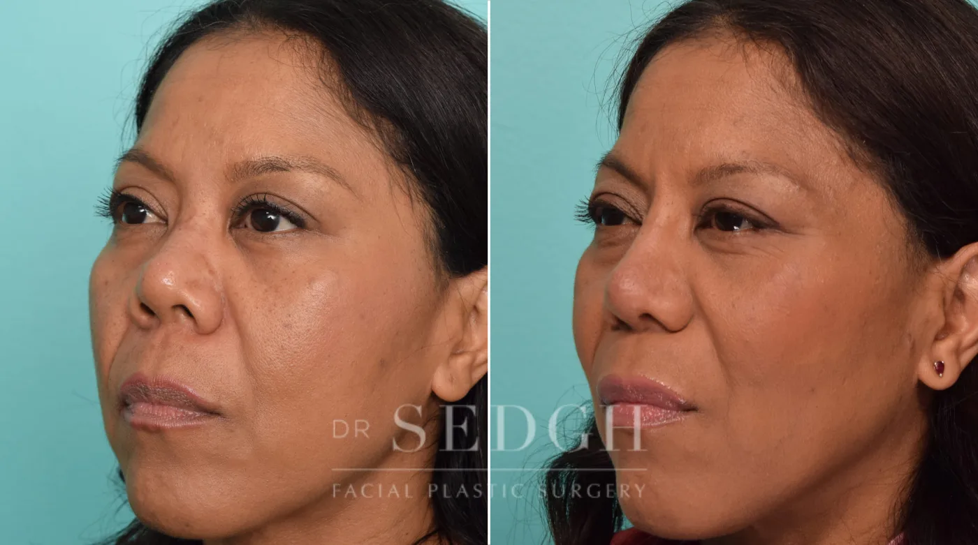 Patient 288 before Asian Rhinoplasty, view 1