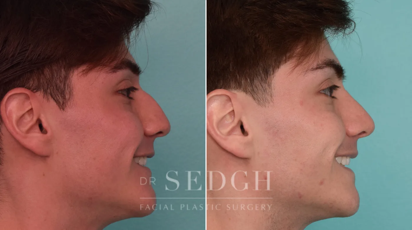 Patient 286 after Male Rhinoplasty, view 1