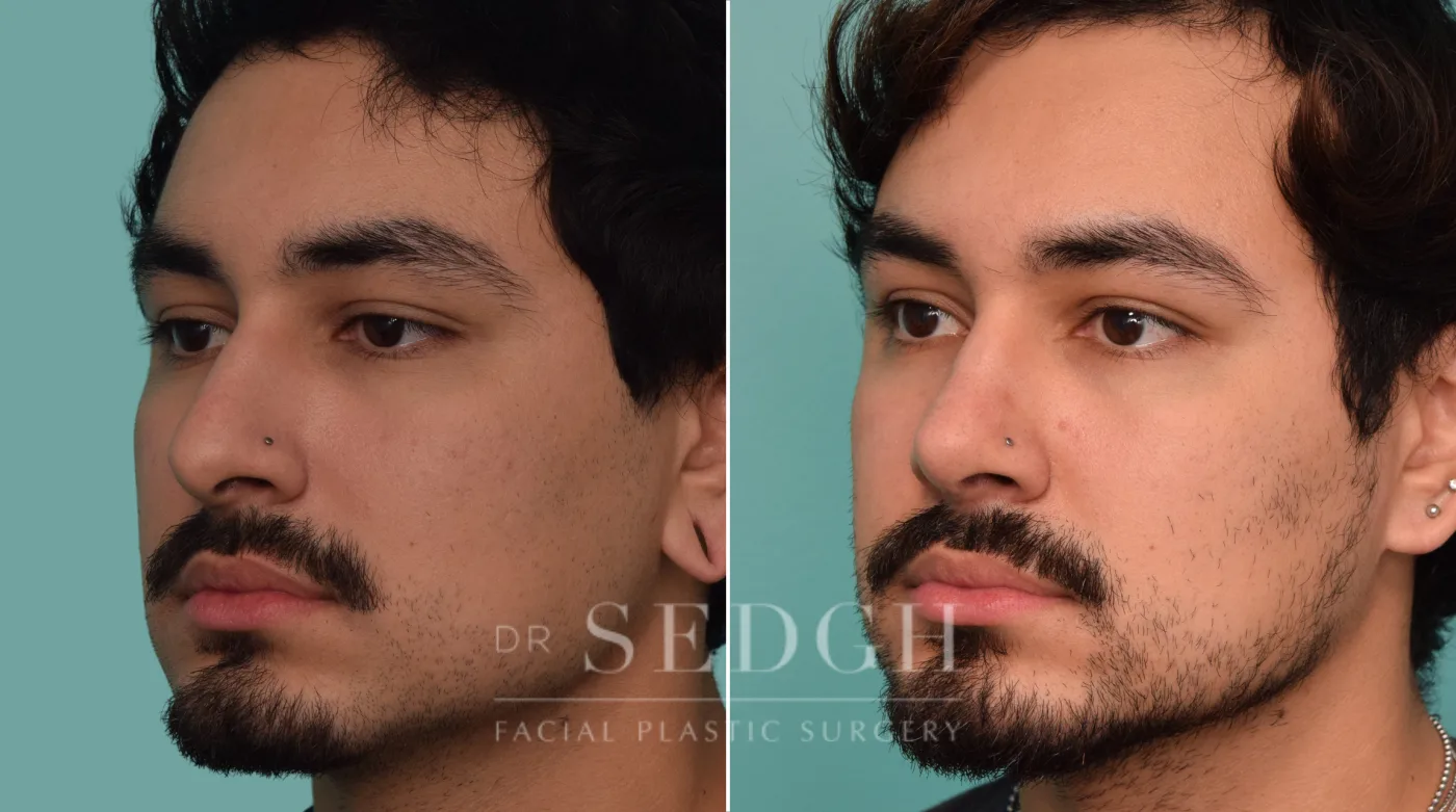 Patient 228 before Rhinoplasty, view 1