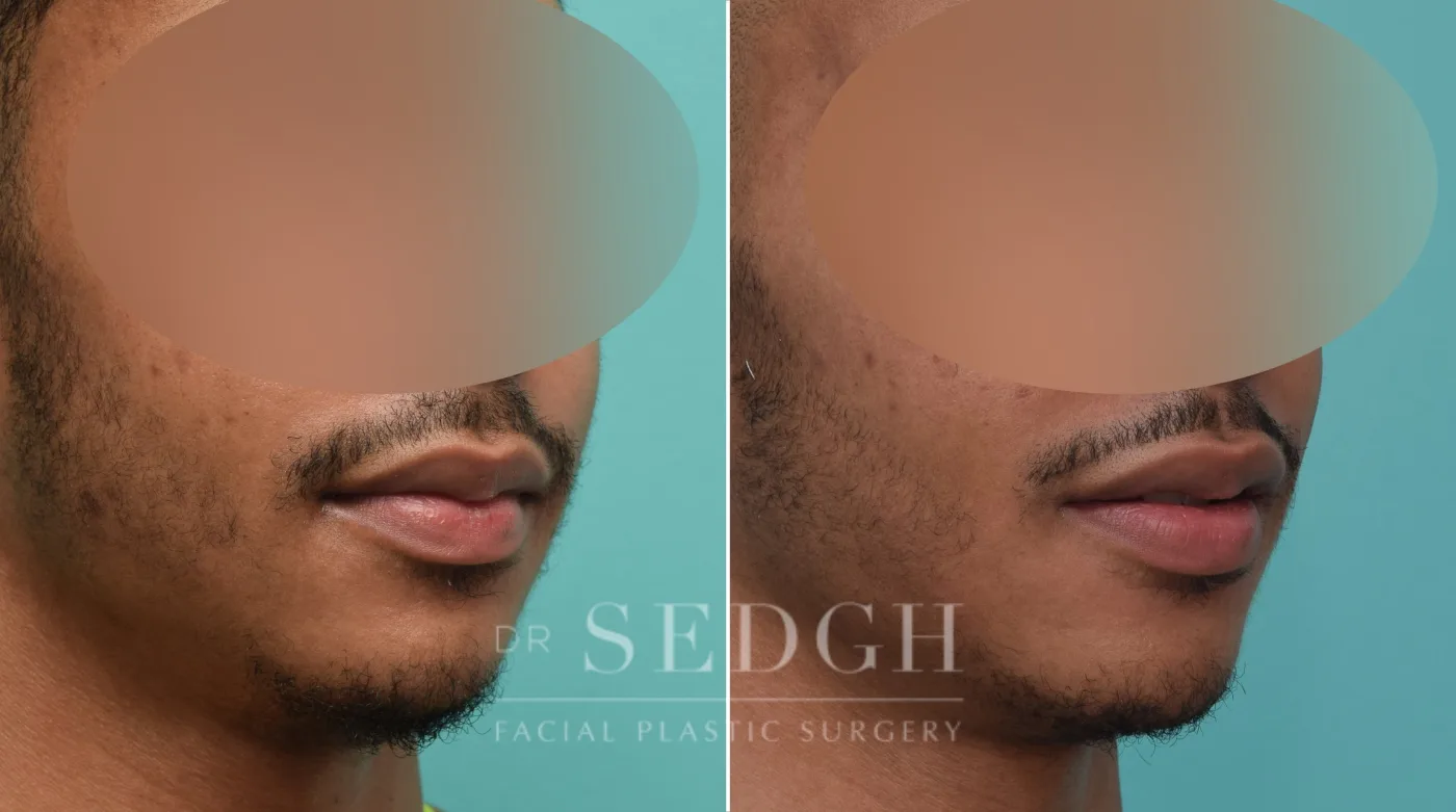 Patient 148 before Chin Augmentation, view 1