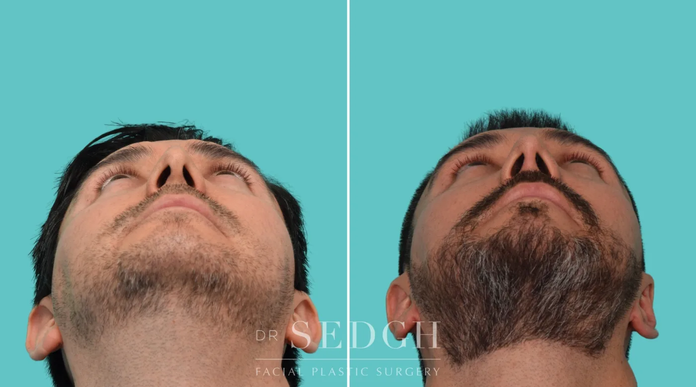 Patient 355 before Hispanic Rhinoplasty, view 3