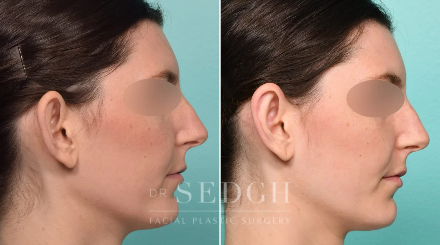 Patient 313 after Ear Pinning Surgery, view 2