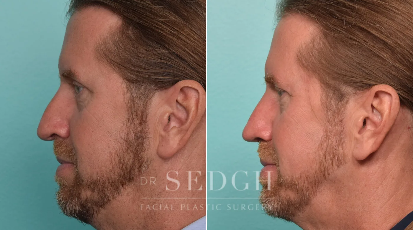 Patient 305 after Crooked Nose Surgery, view 2