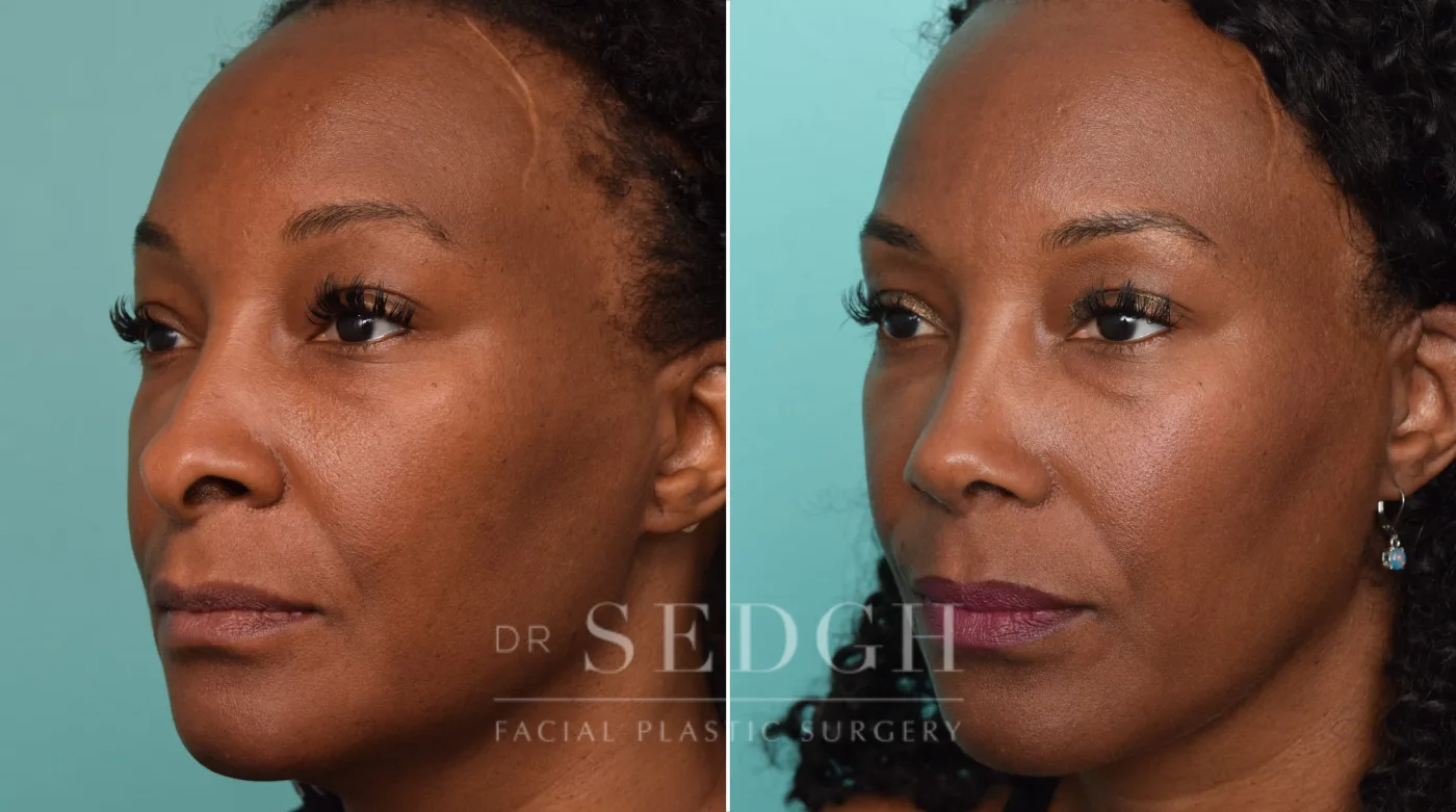 Patient 246 before African American Rhinoplasty, view 1