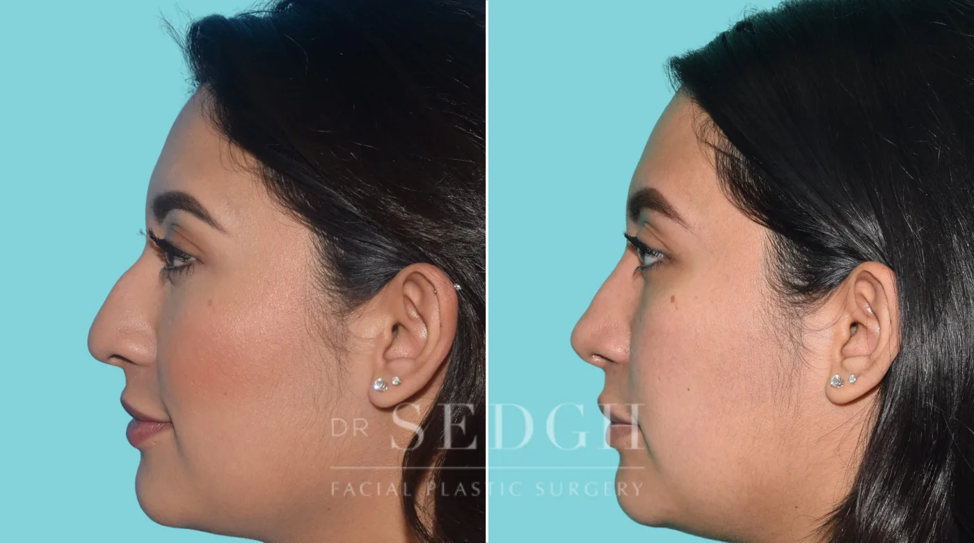 Patient 34 after Rhinoplasty, view 1