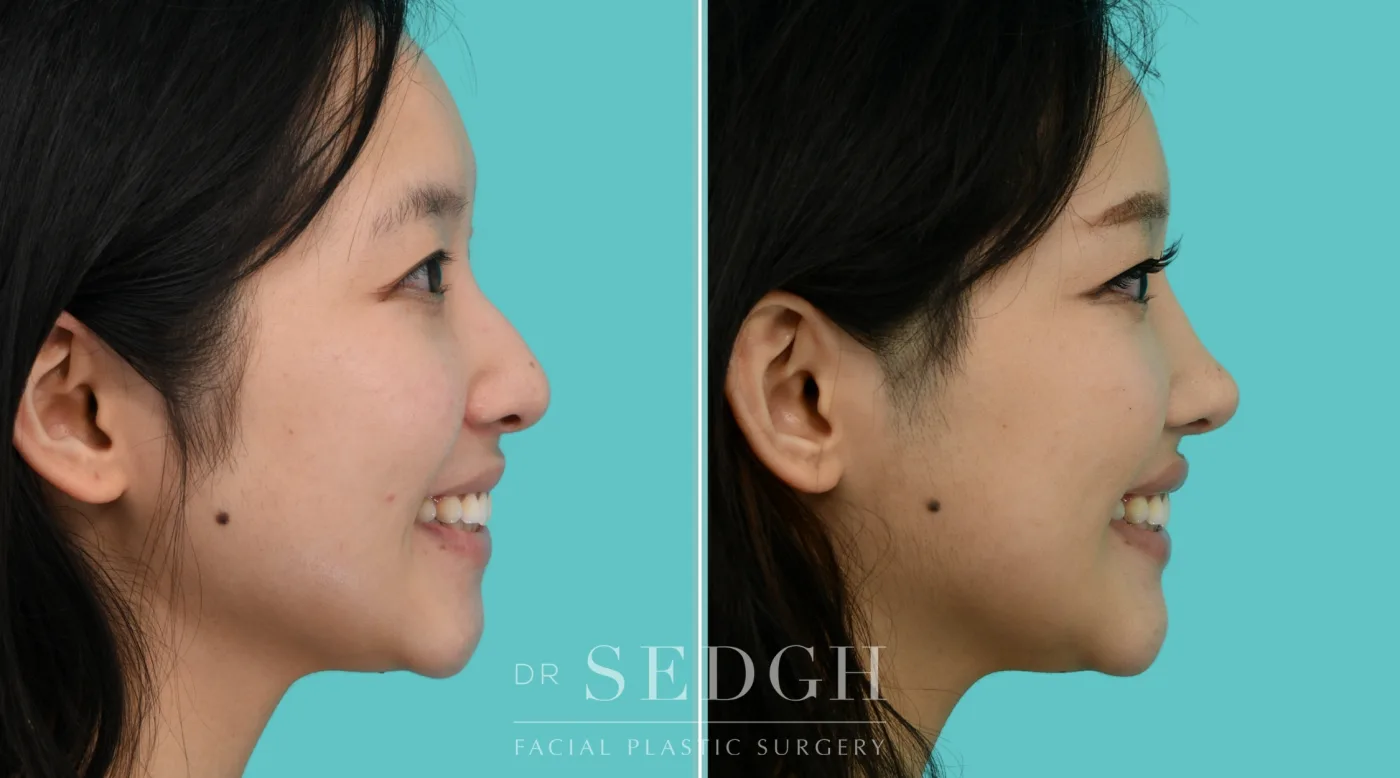 Patient 353 after Asian Rhinoplasty, view 2