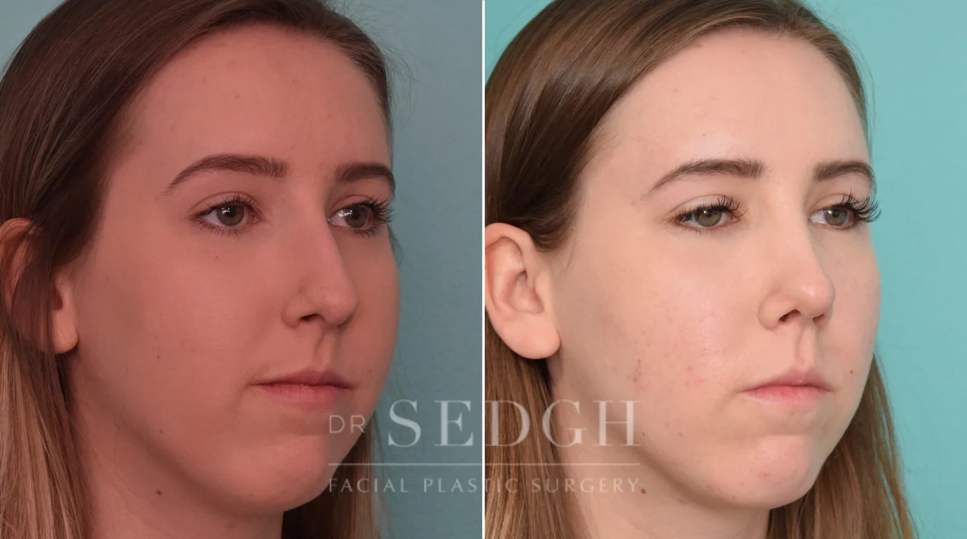 Patient 226 before Facial Fillers, view 2