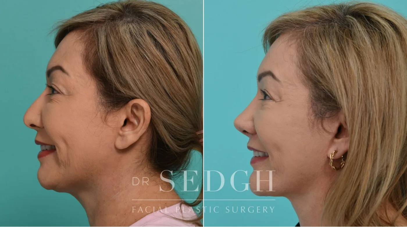 Patient 341 before Face Lift, view 2