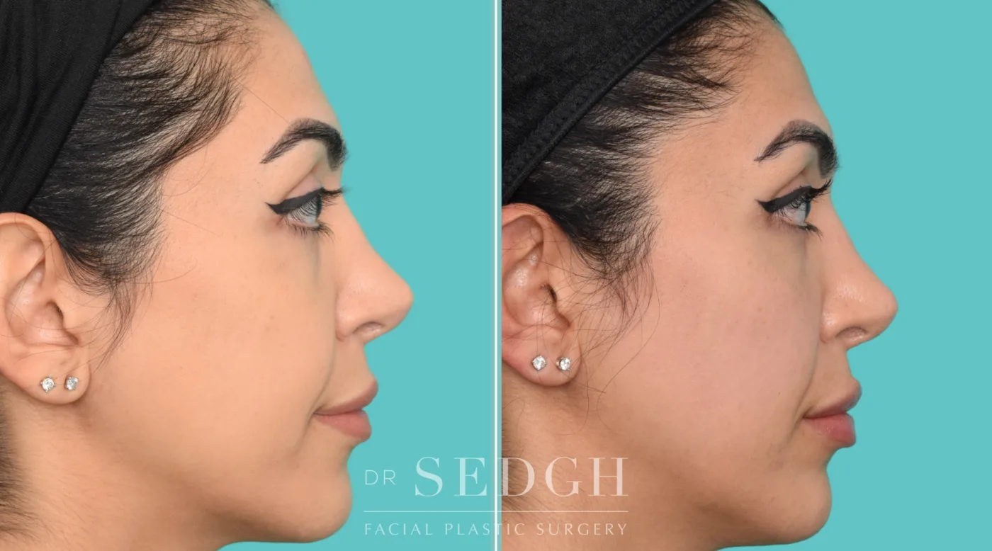Patient 362 after Flat Helix Repair / Helical Reduction Otoplasty, view 1