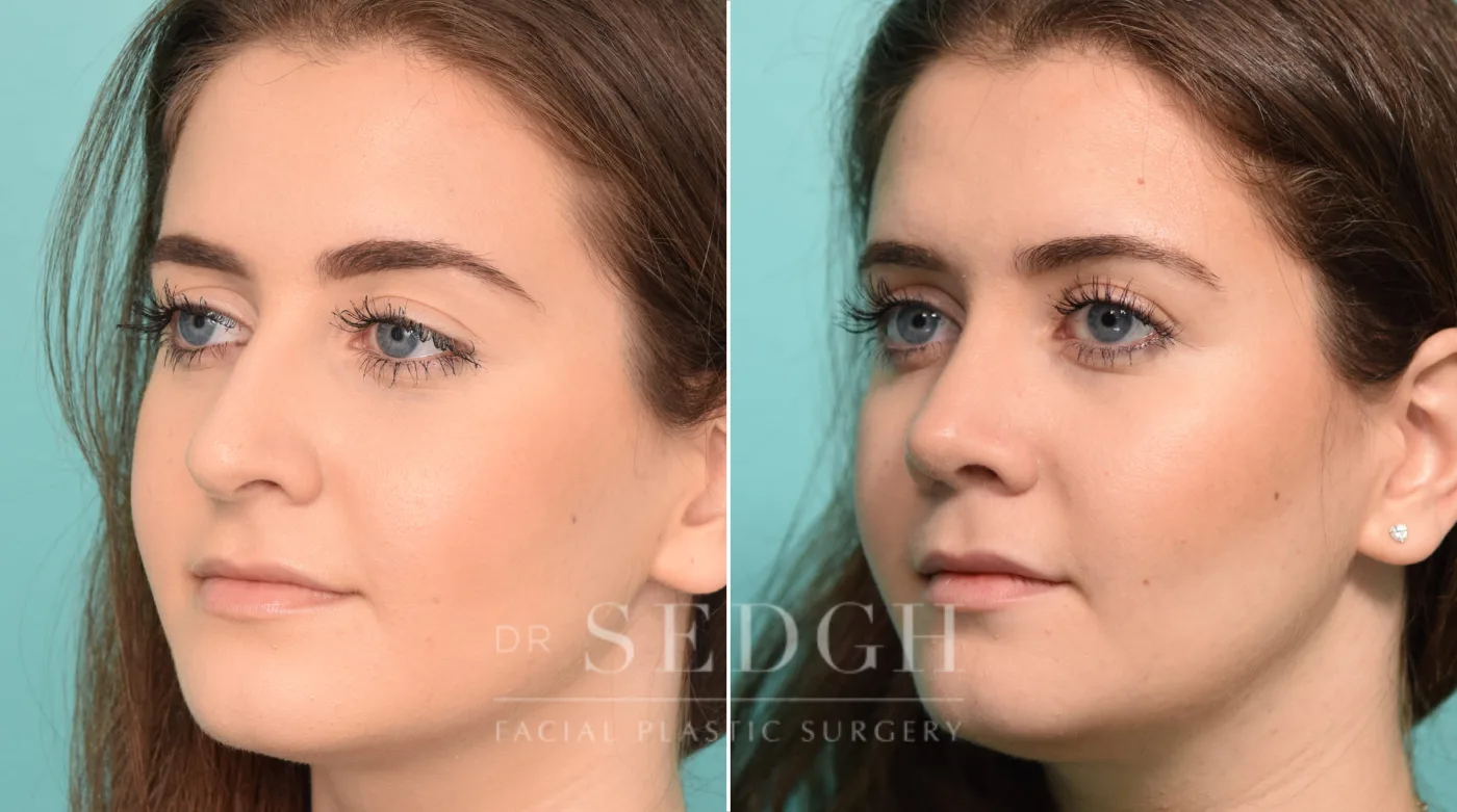Patient 244 before Rhinoplasty, view 1
