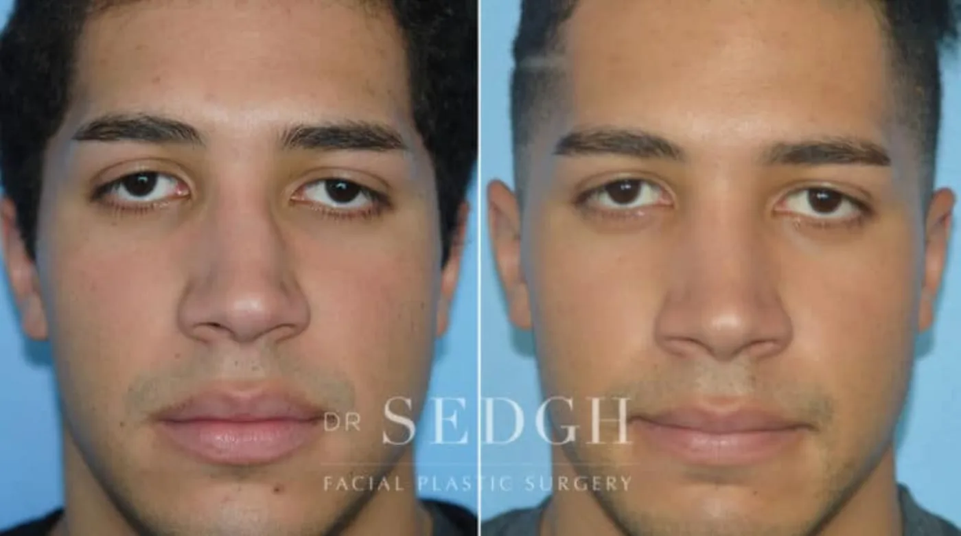 Patient 6 before Crooked Nose Surgery, view 1