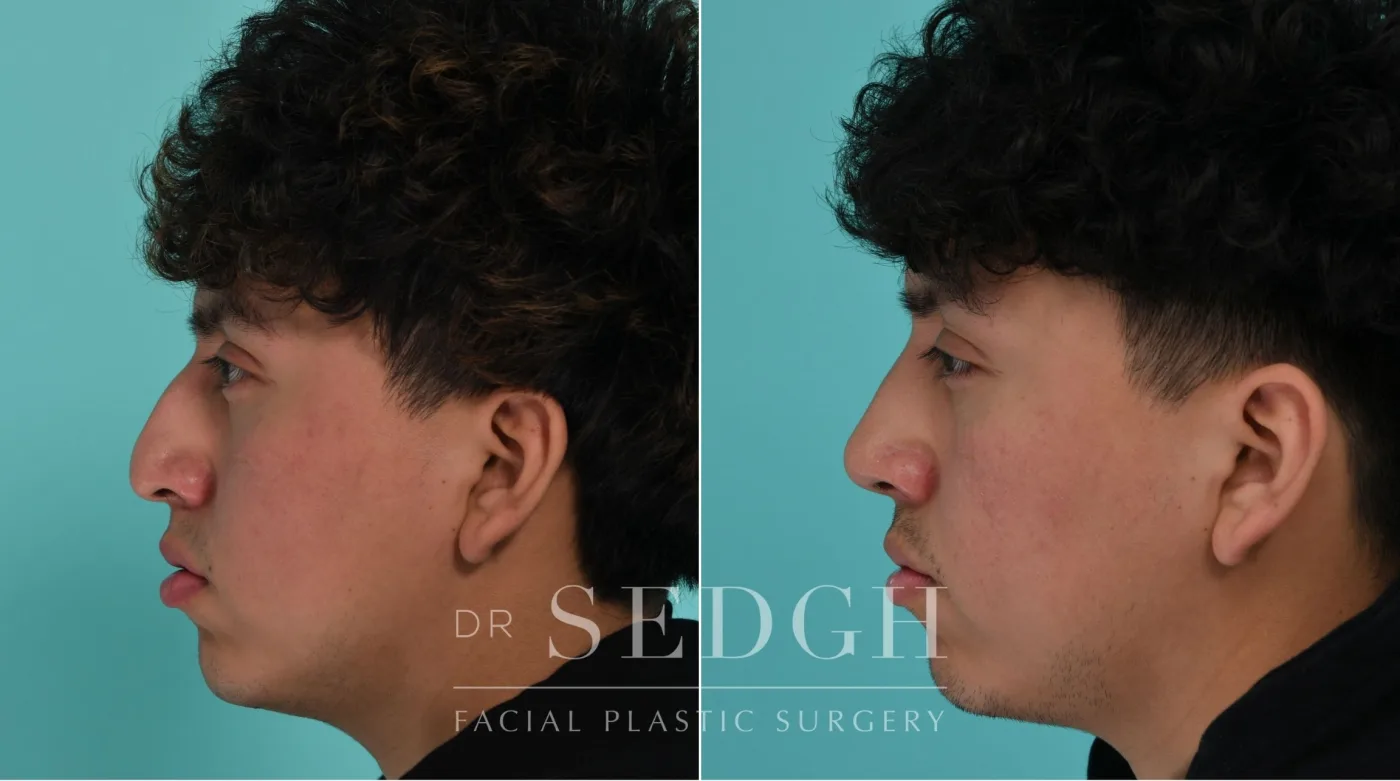 Patient 339 after Male Rhinoplasty, view 1