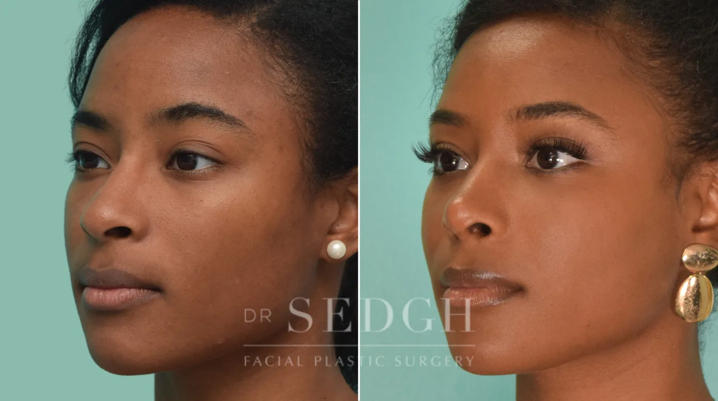 Patient 190 before Female Rhinoplasty, view 2