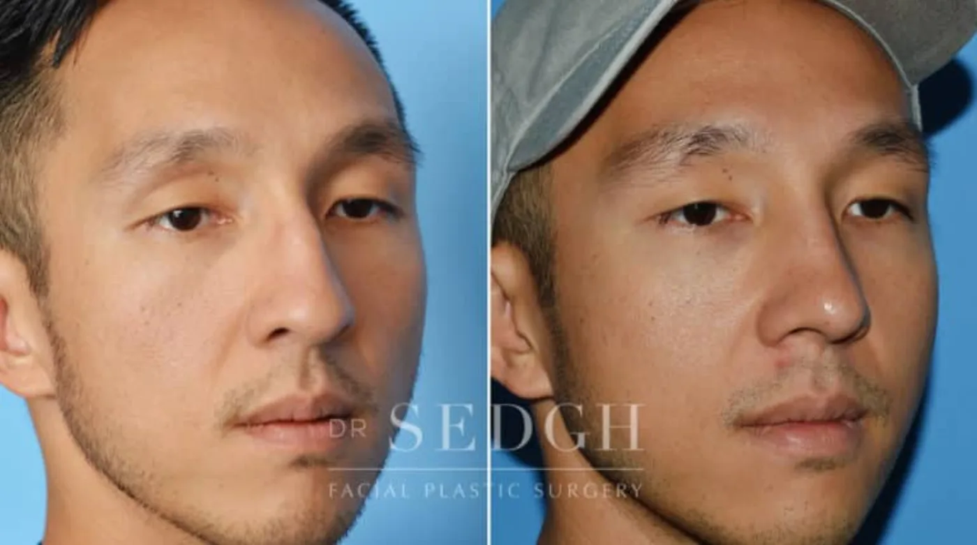 Patient 4 before Middle Eastern Rhinoplasty, view 1