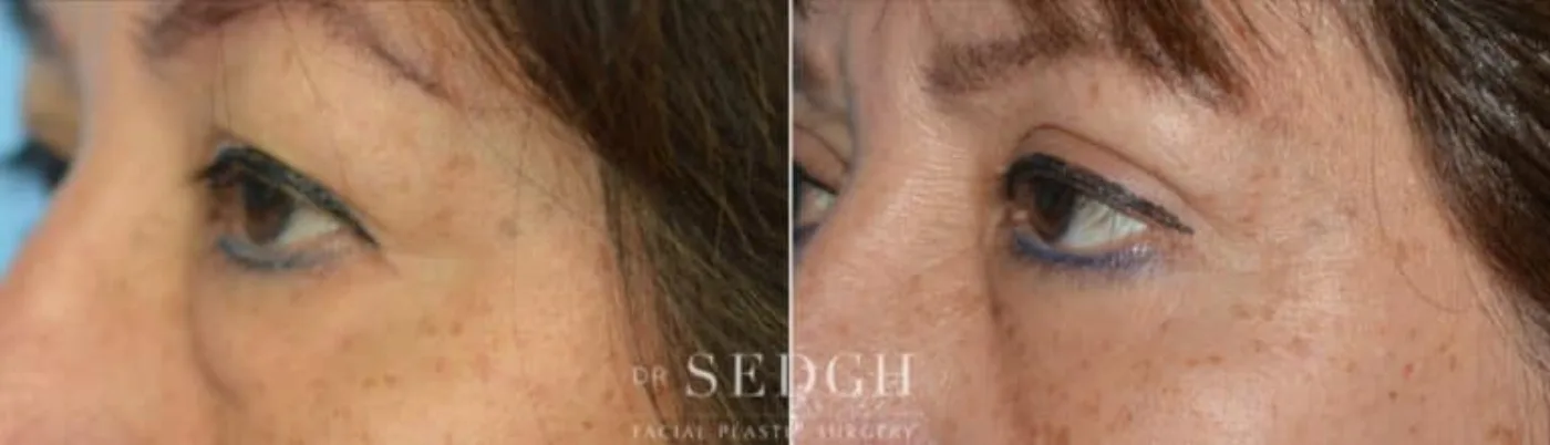 Patient 6 after Upper Blepharoplasty, view 1