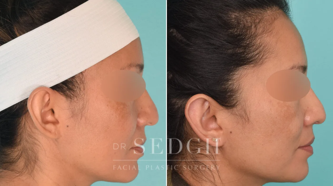 Patient 198 after Ear Pinning Surgery, view 2