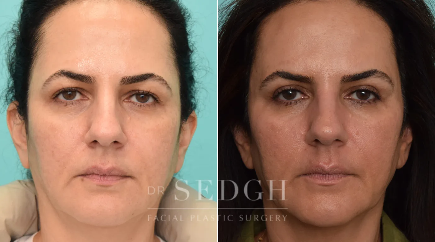 Patient 252 after Brow Lift, view 1