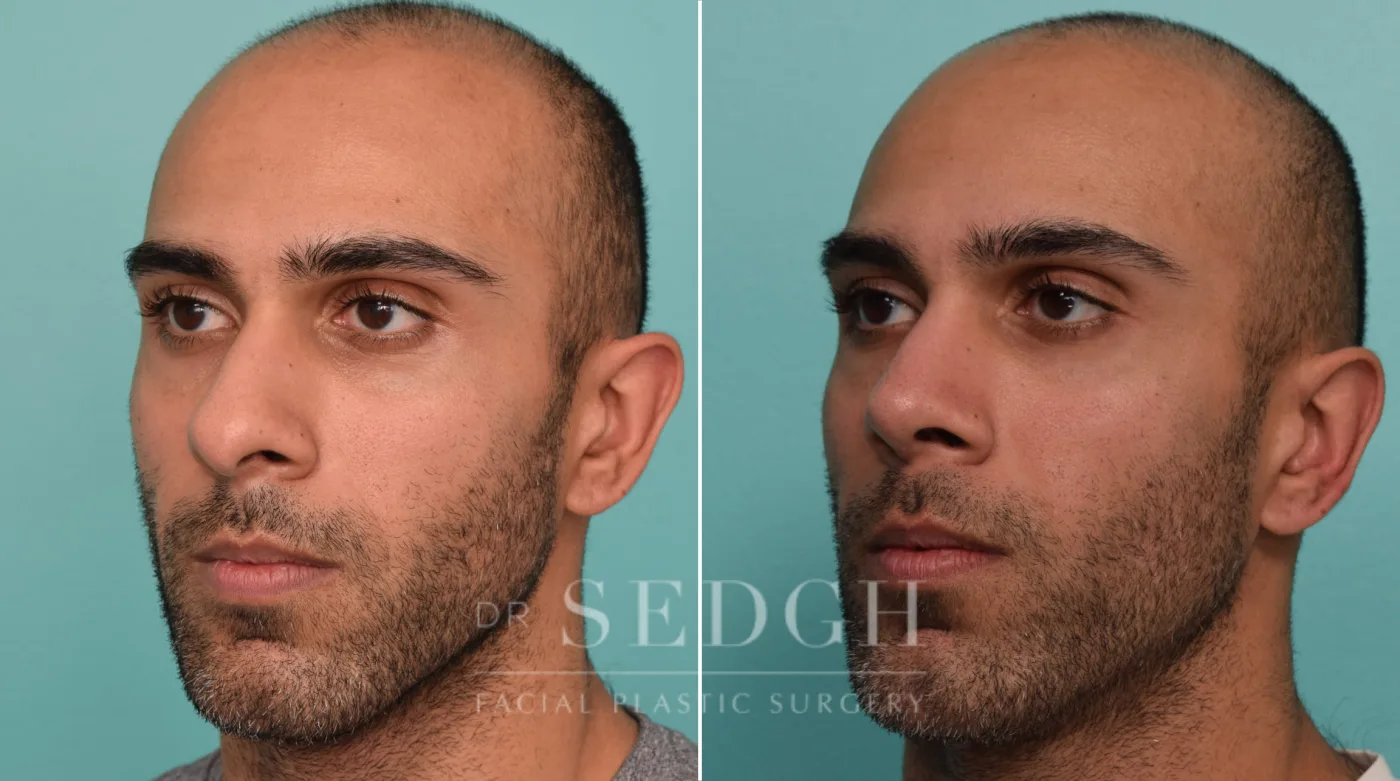 Patient 263 before Male Rhinoplasty, view 2