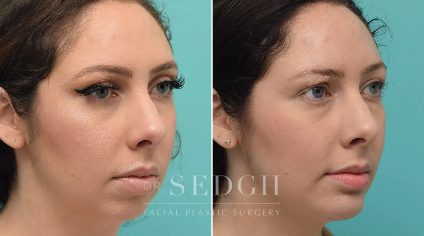Patient 145 before Chin Augmentation, view 1