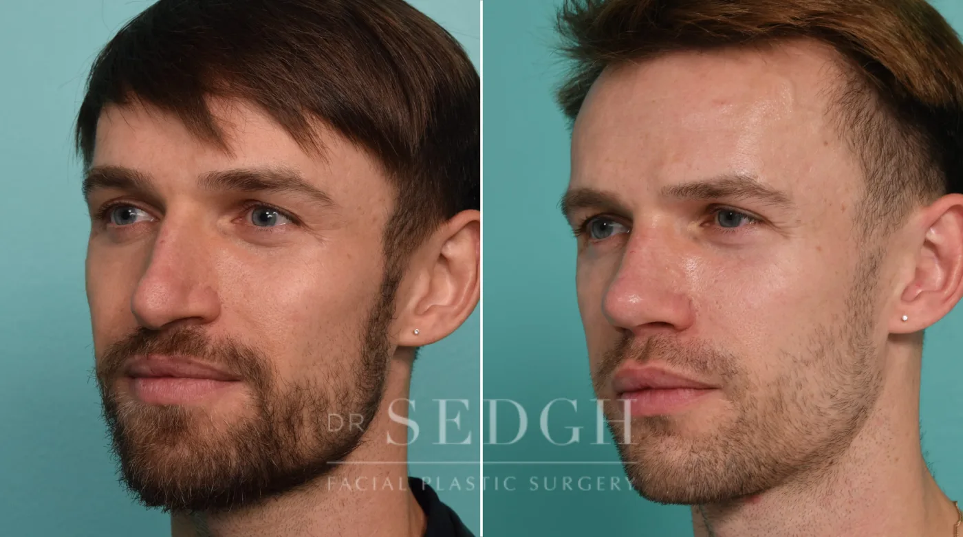 Patient 330 before Revision Rhinoplasty, view 2