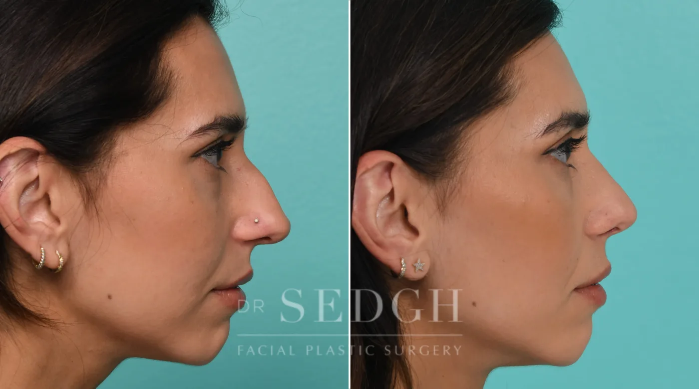 Patient 325 after Female Rhinoplasty, view 1