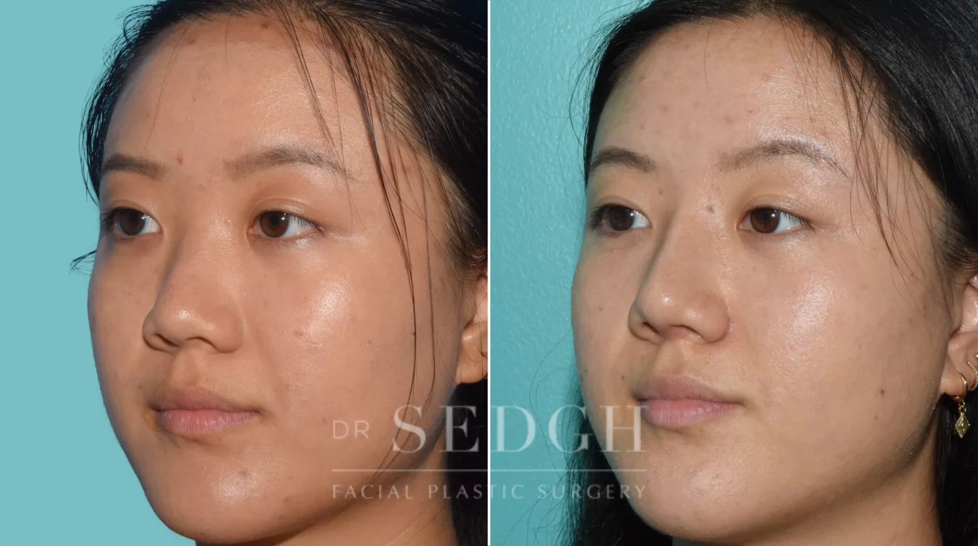 Patient 36 before Middle Eastern Rhinoplasty, view 2