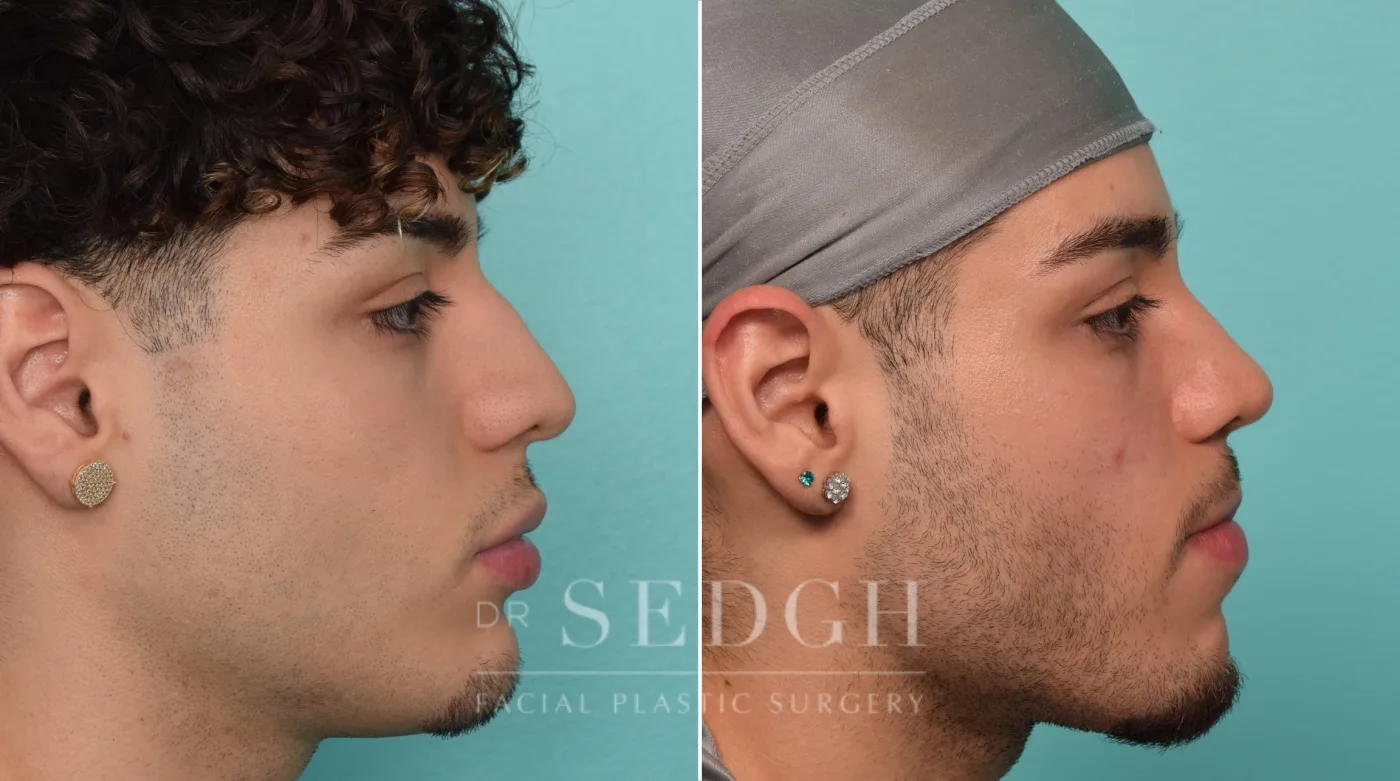 Patient 289 after Rhinoplasty, view 2