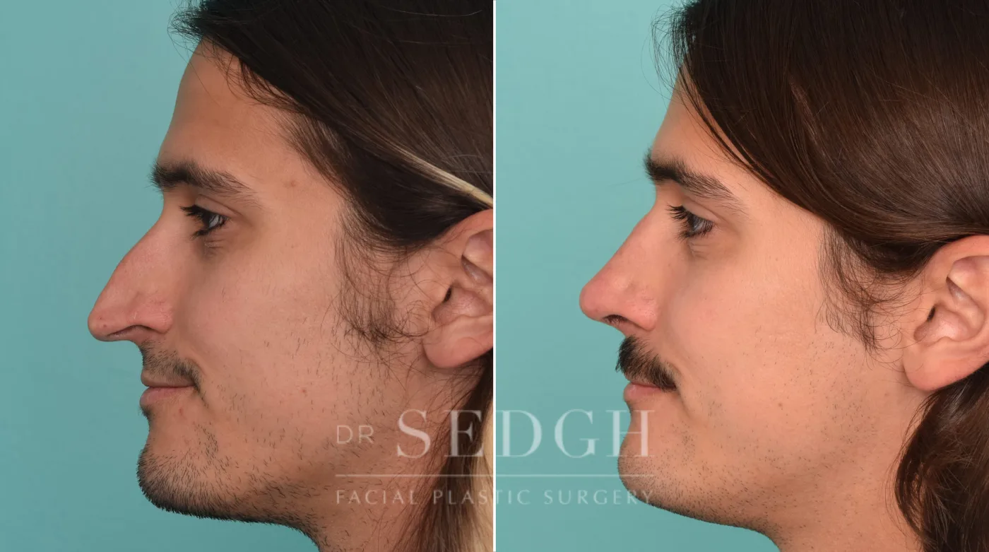 Patient 224 after Rhinoplasty, view 1