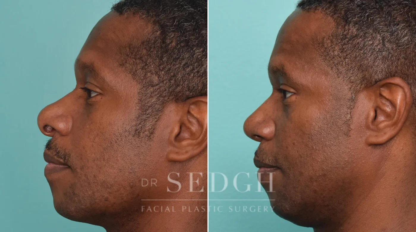 Patient 272 after African American Rhinoplasty, view 1