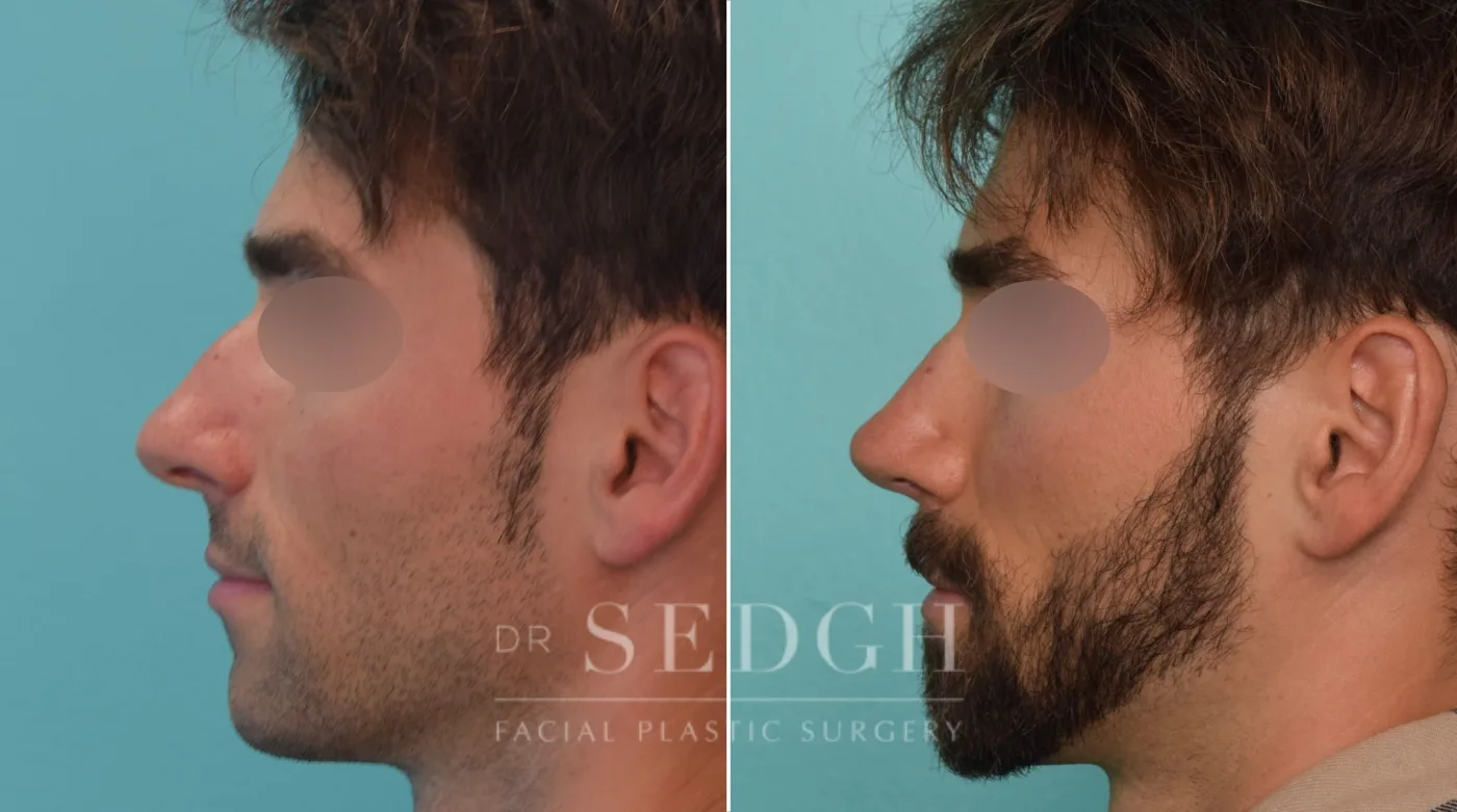 Patient 273 after Male Rhinoplasty, view 1