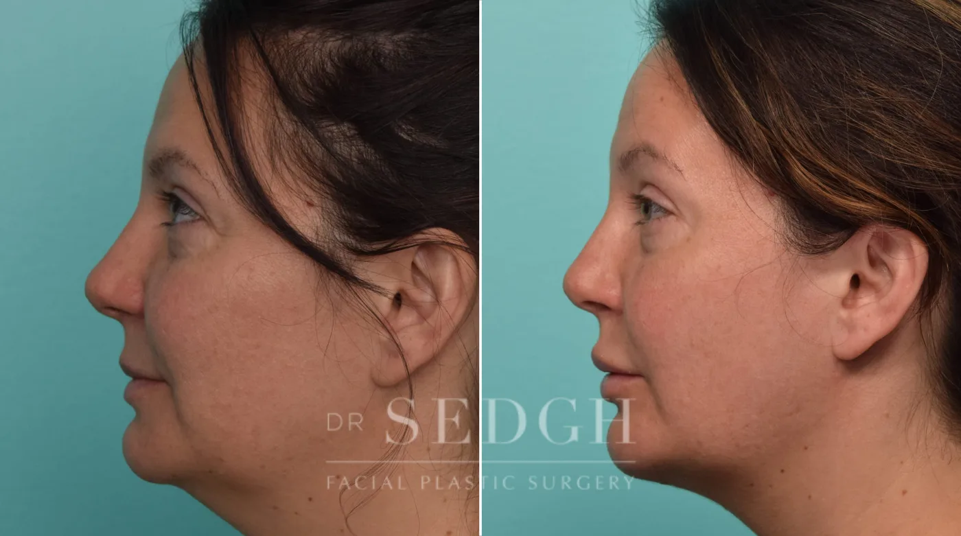 Patient 310 after Chin Augmentation, view 1