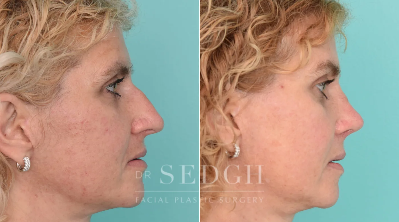 Patient 213 after Brow Lift, view 1