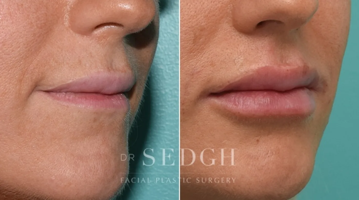 Patient 1 after lip augmentation, view 1