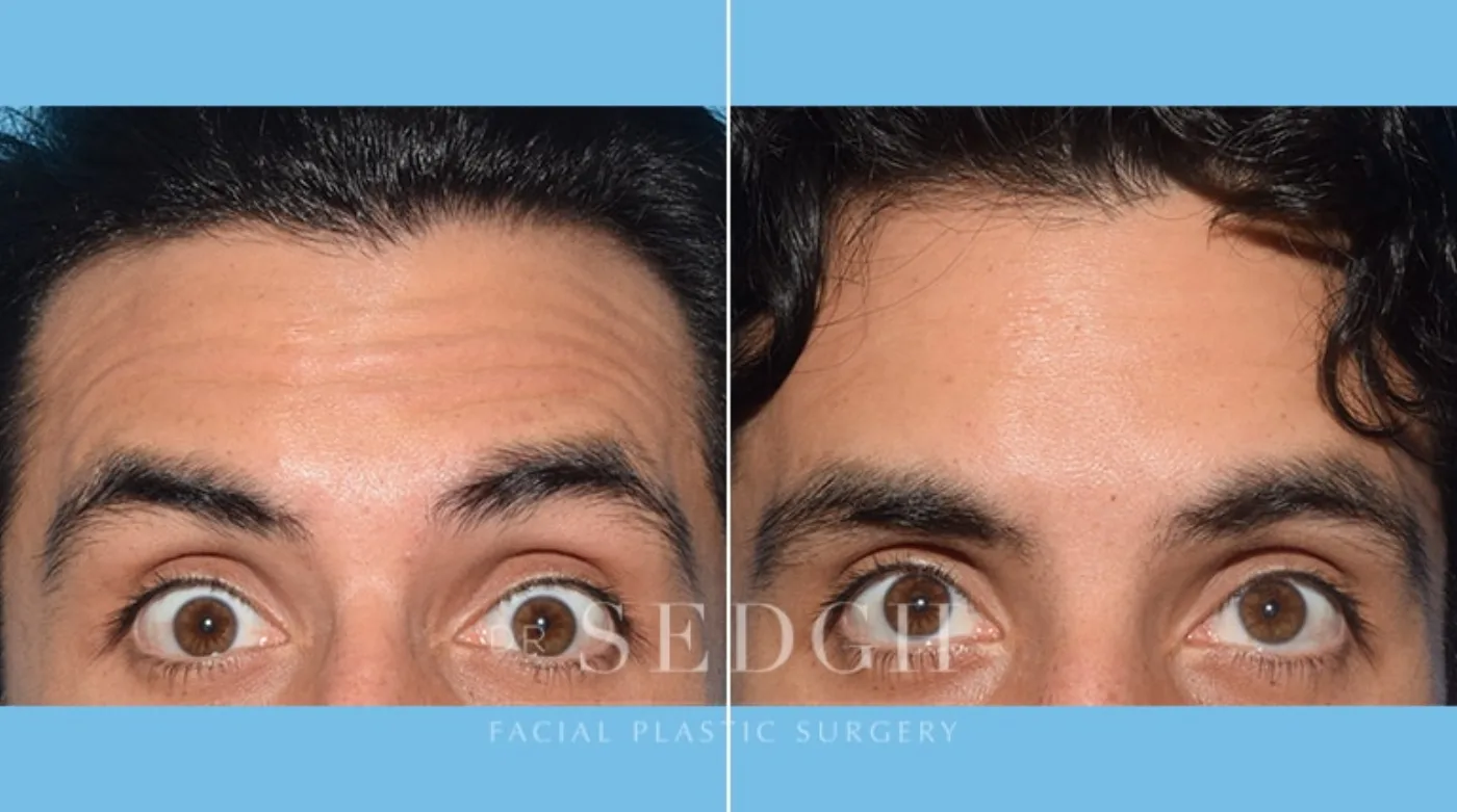 Patient 2 before Wrinkle Relaxers, view 1