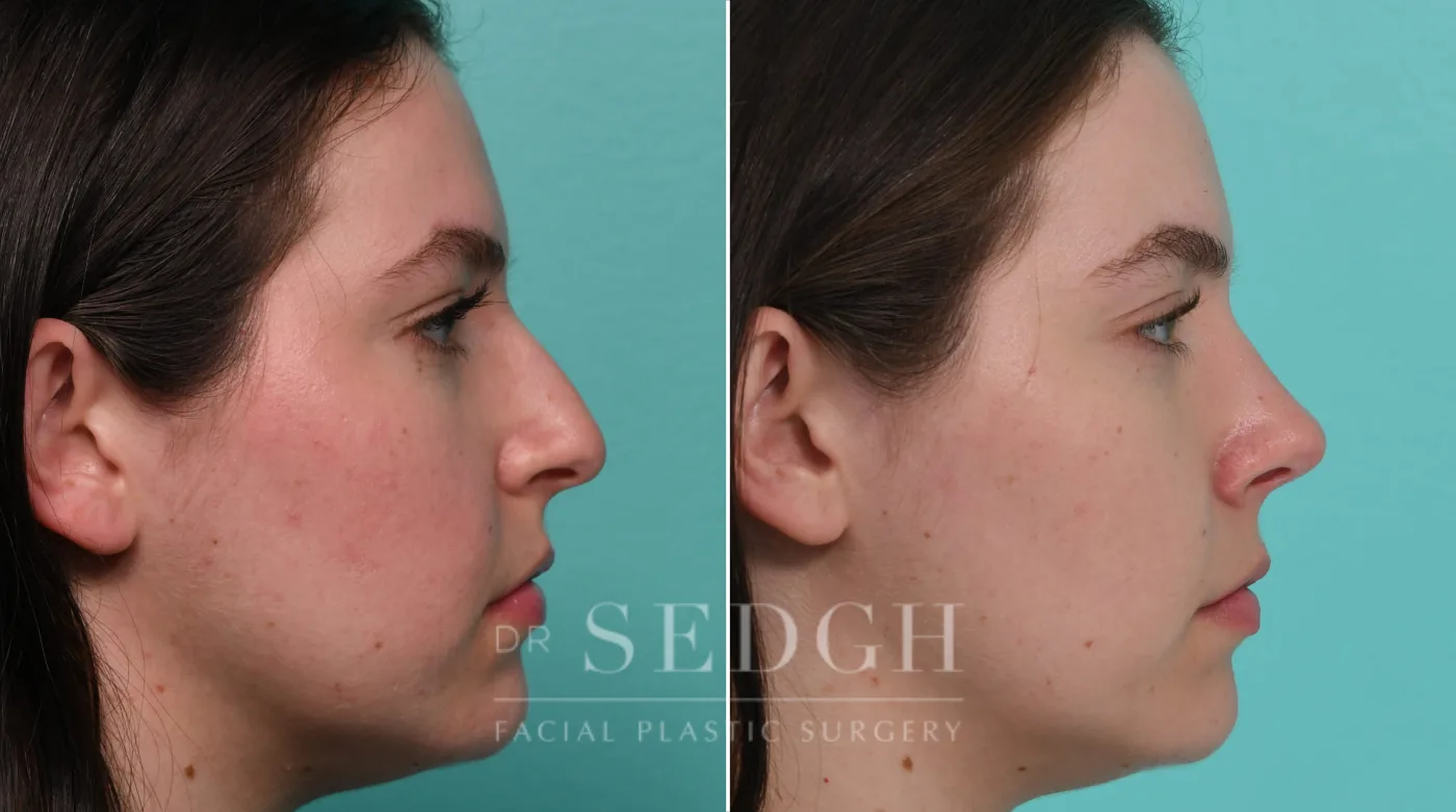 Patient 326 after Rhinoplasty, view 2