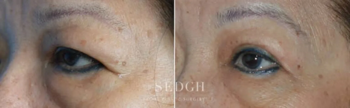 Patient 7 after Brow Lift, view 1