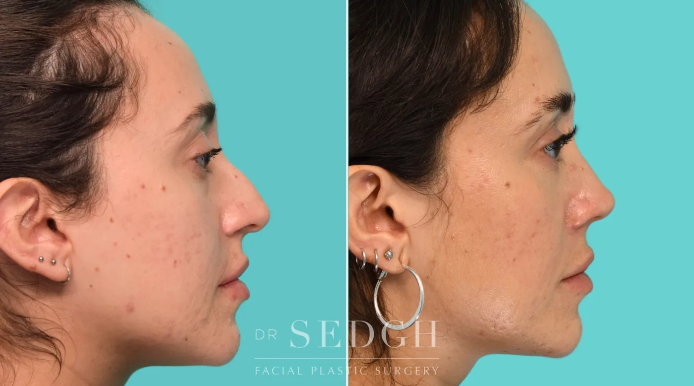 Patient 340 before Revision Rhinoplasty, view 1
