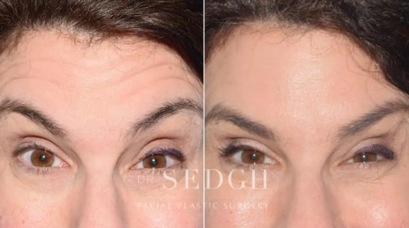 Patient 9 before Wrinkle Relaxers, view 1