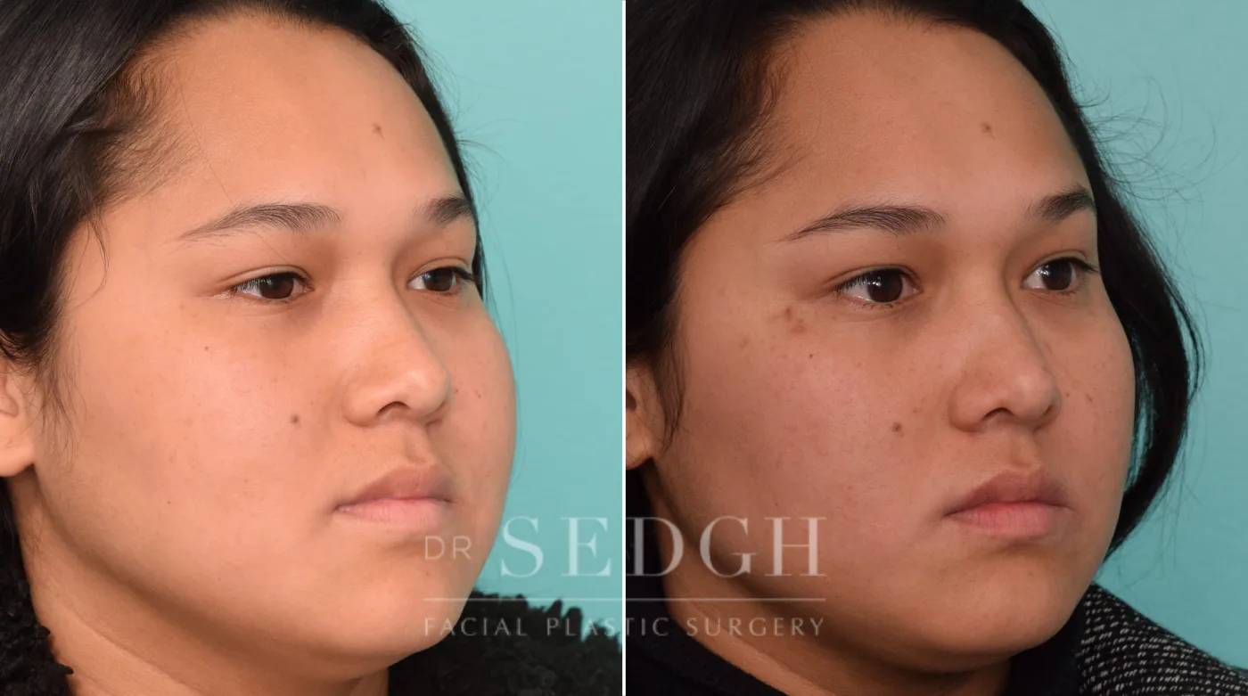 Patient 238 before Buccal Fat Reduction, view 1