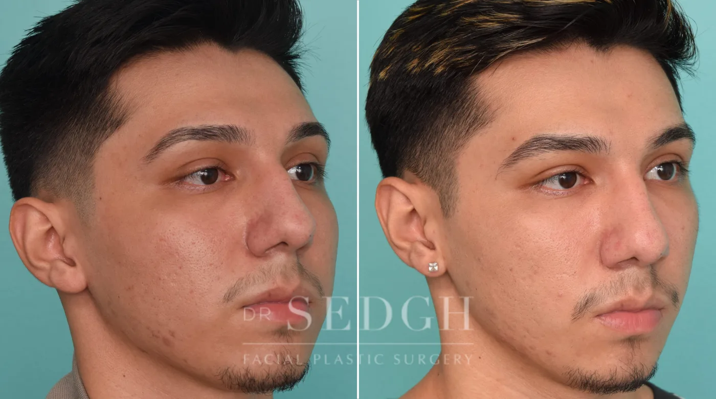 Patient 257 before Ear Pinning Surgery, view 2