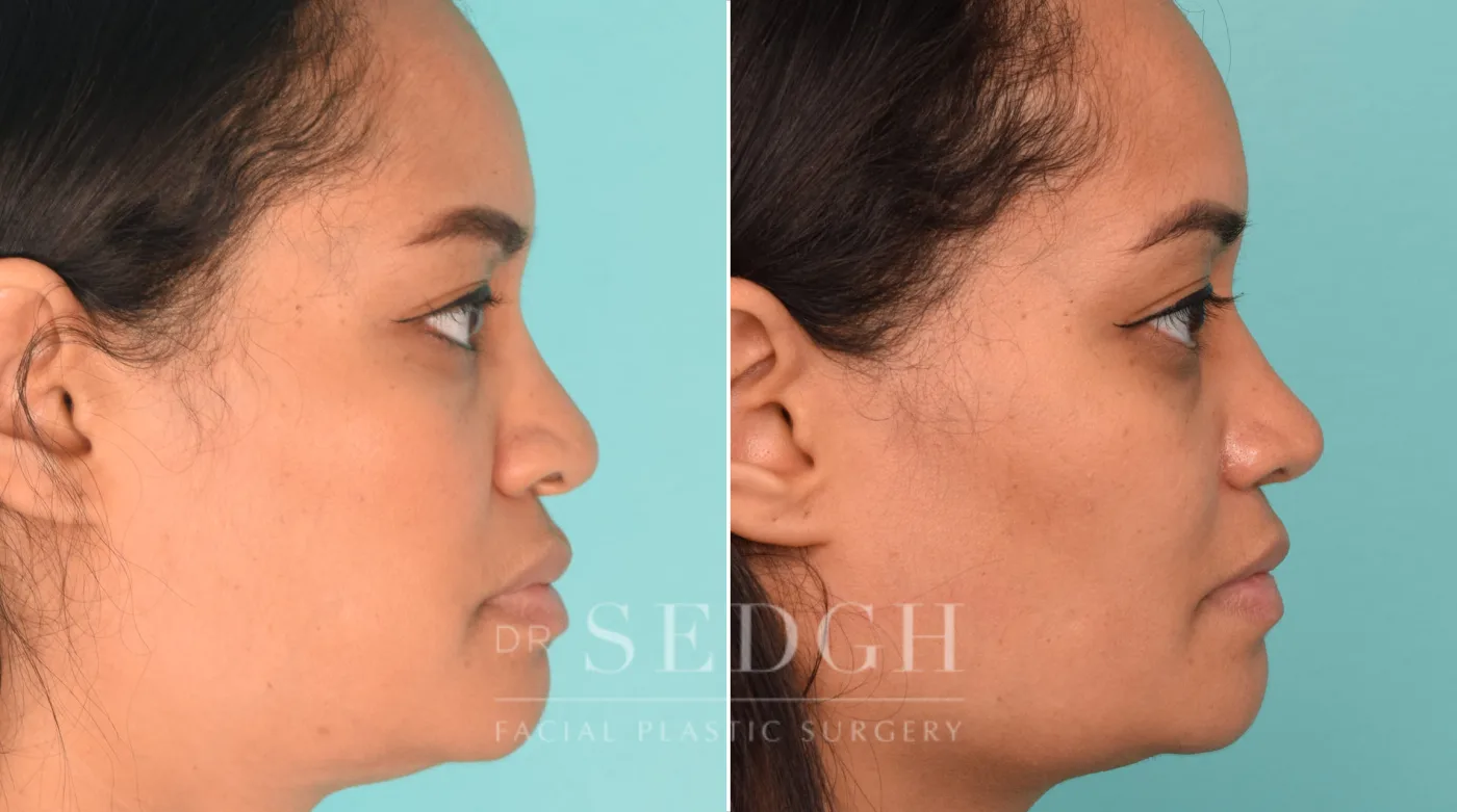 Patient 229 after Female Rhinoplasty, view 2
